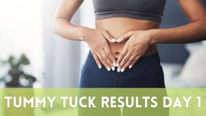 Tummy tuck results day 1